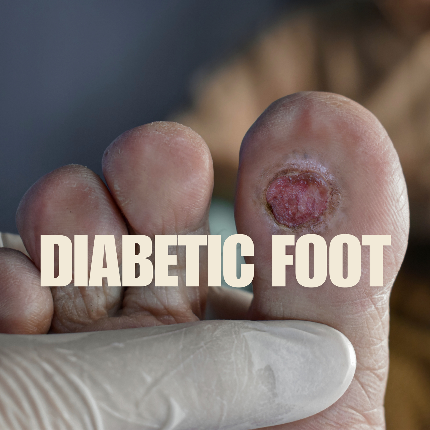 Diabetic Foot Care mumtaz care