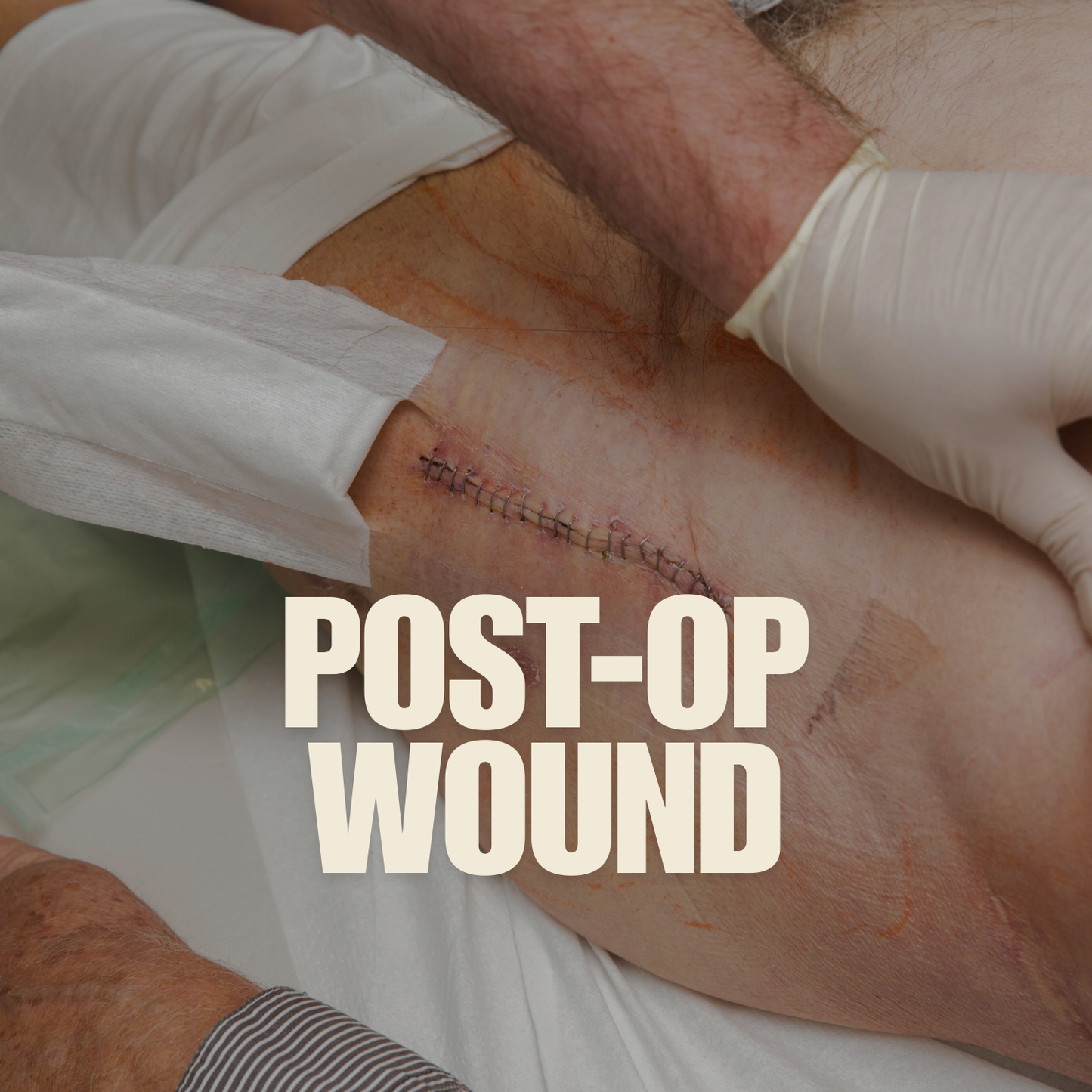 Post Surgical Wound mumtaz care