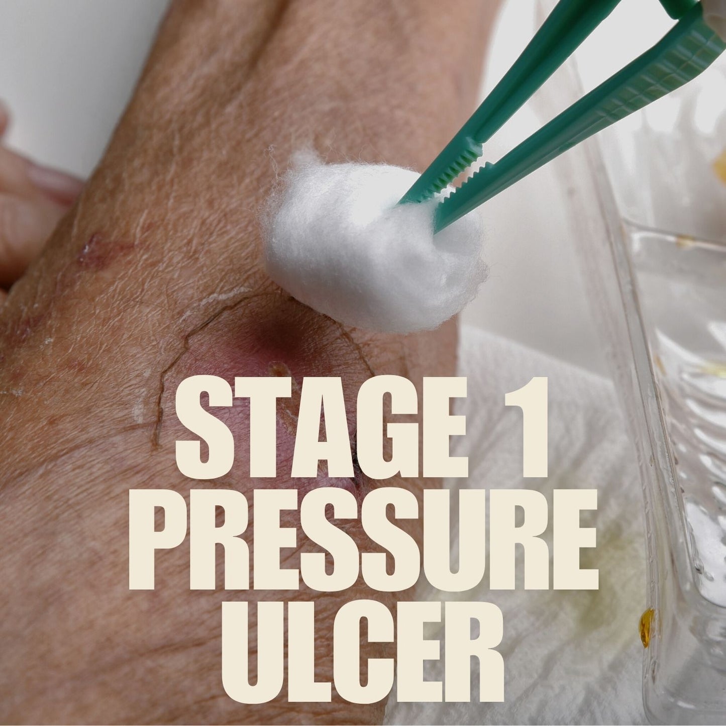 Pressure Ulcer-Stage 1 mumtaz care