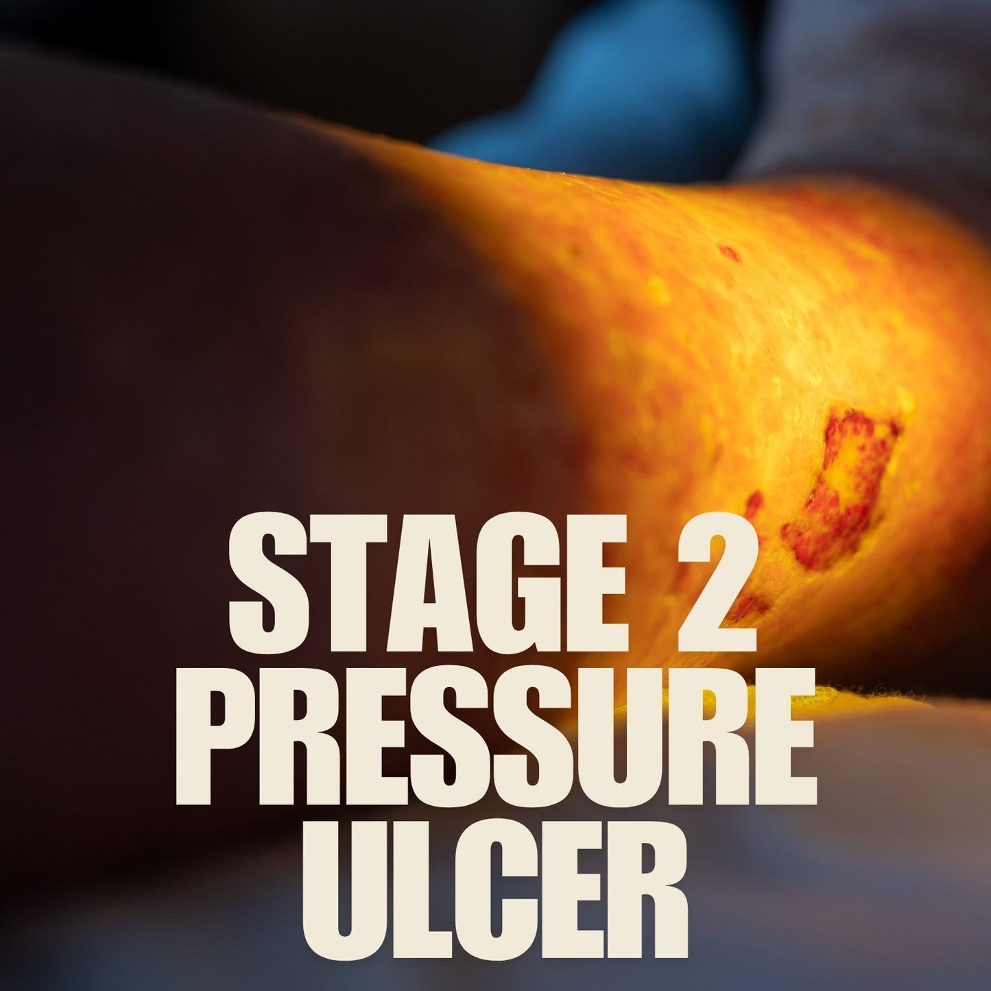 Pressure Ulcer-Stage 2 mumtaz care