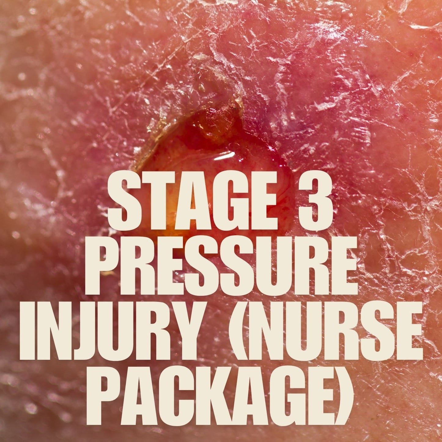 Pressure Ulcer-Stage 3 (Nurse Package) mumtaz care