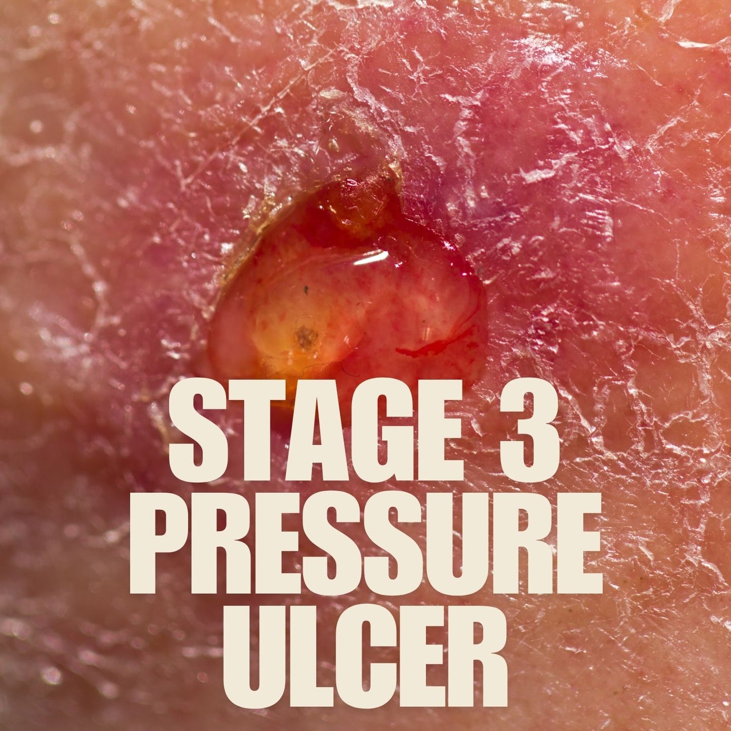 Pressure Ulcer-Stage 3 mumtaz care