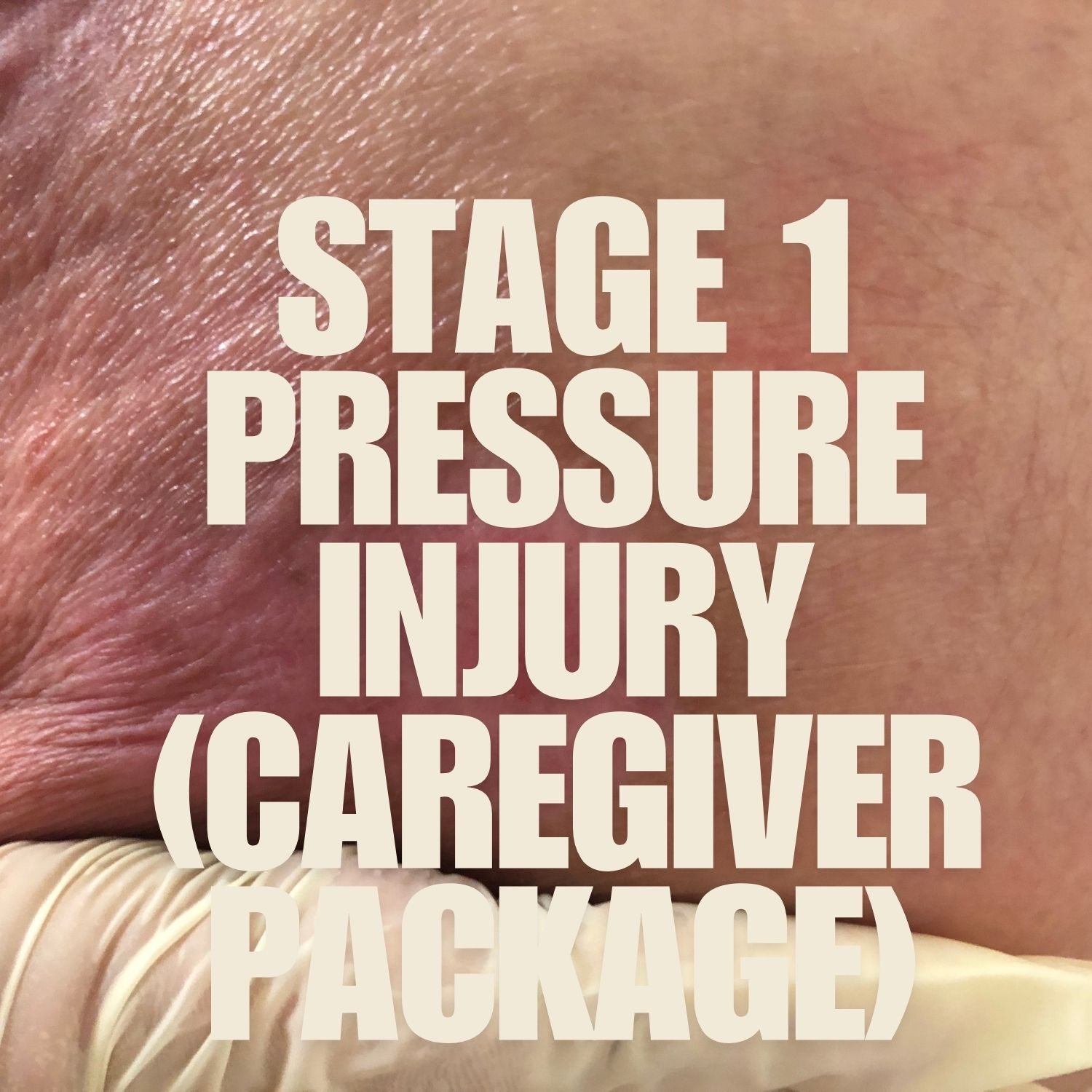 Pressure Ulcer-Stage 1 (Caregiver Package) mumtaz care